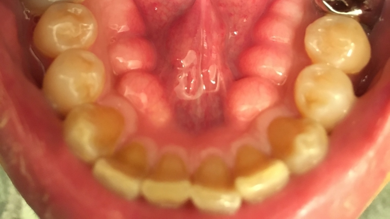 倉敷市の歯ぎしり・食いしばりの治療 （ナイトガード）