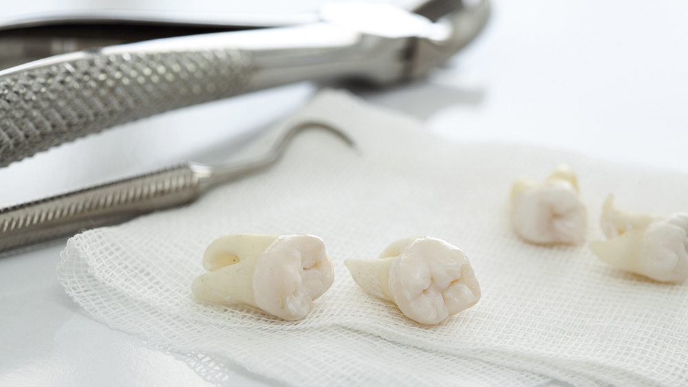 倉敷市の親知らずの抜歯・治療